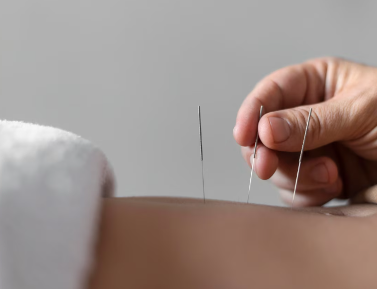 Acupuntura médica mostra eficácia contra dores nas costas, ombros e joelhos