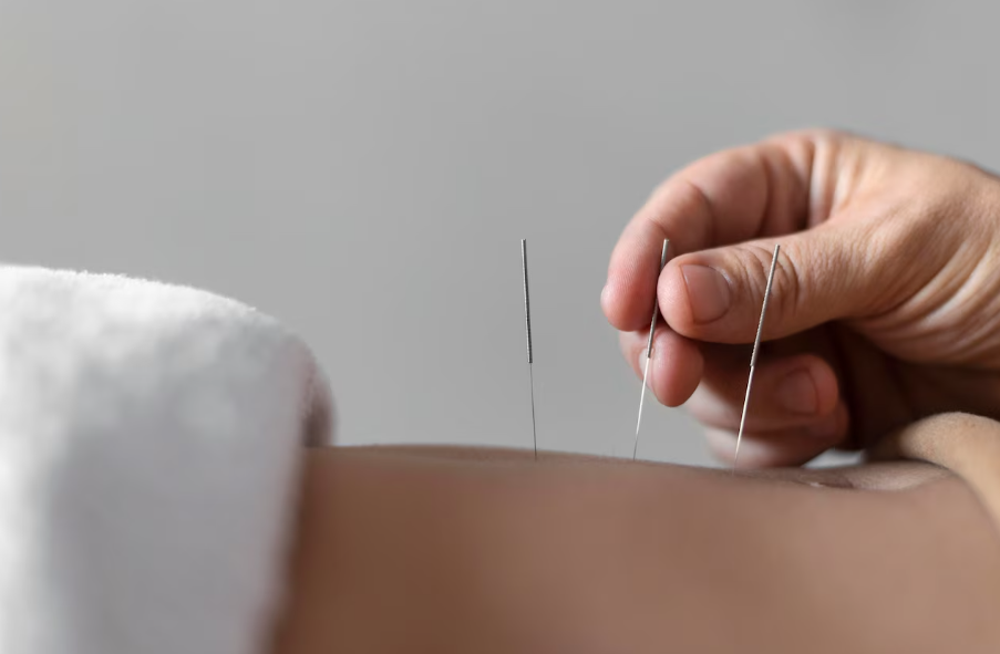 Acupuntura médica mostra eficácia contra dores nas costas, ombros e joelhos